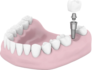 dentalimplants