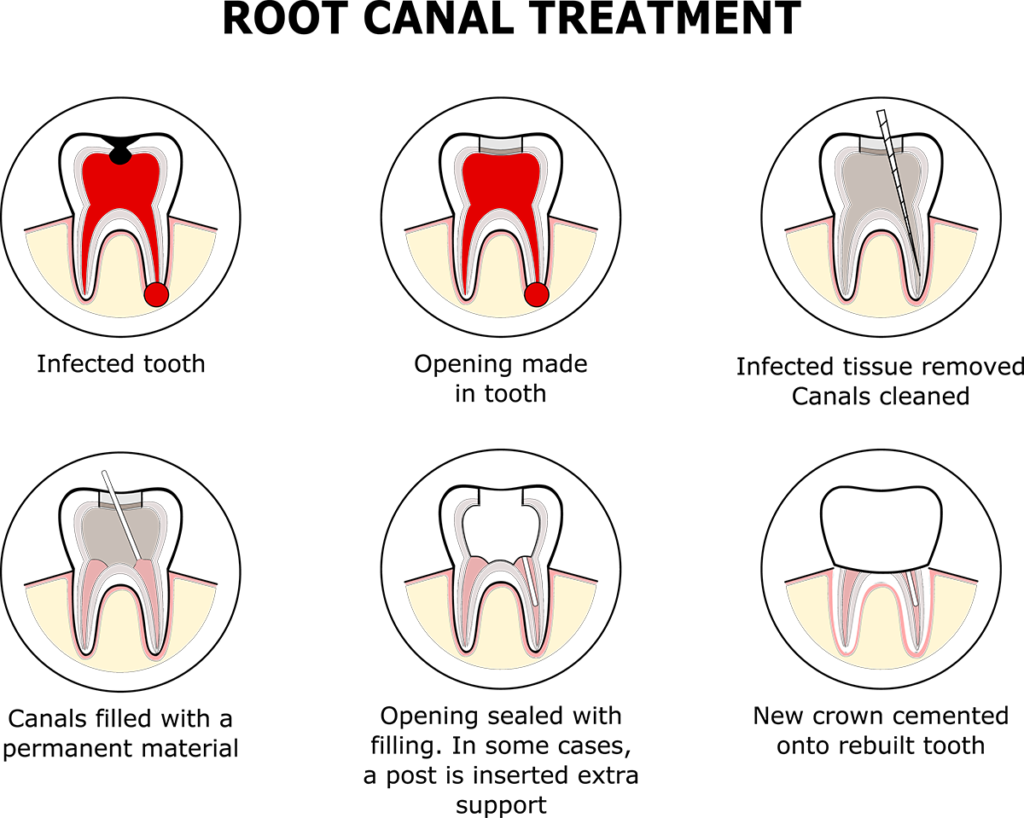 root canal treatment graphic