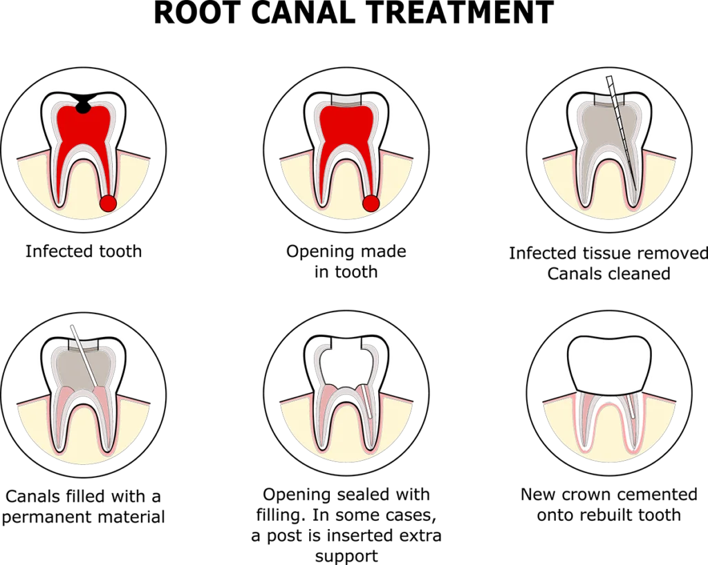 root canal treatment graphic