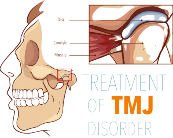 TMJ graphic